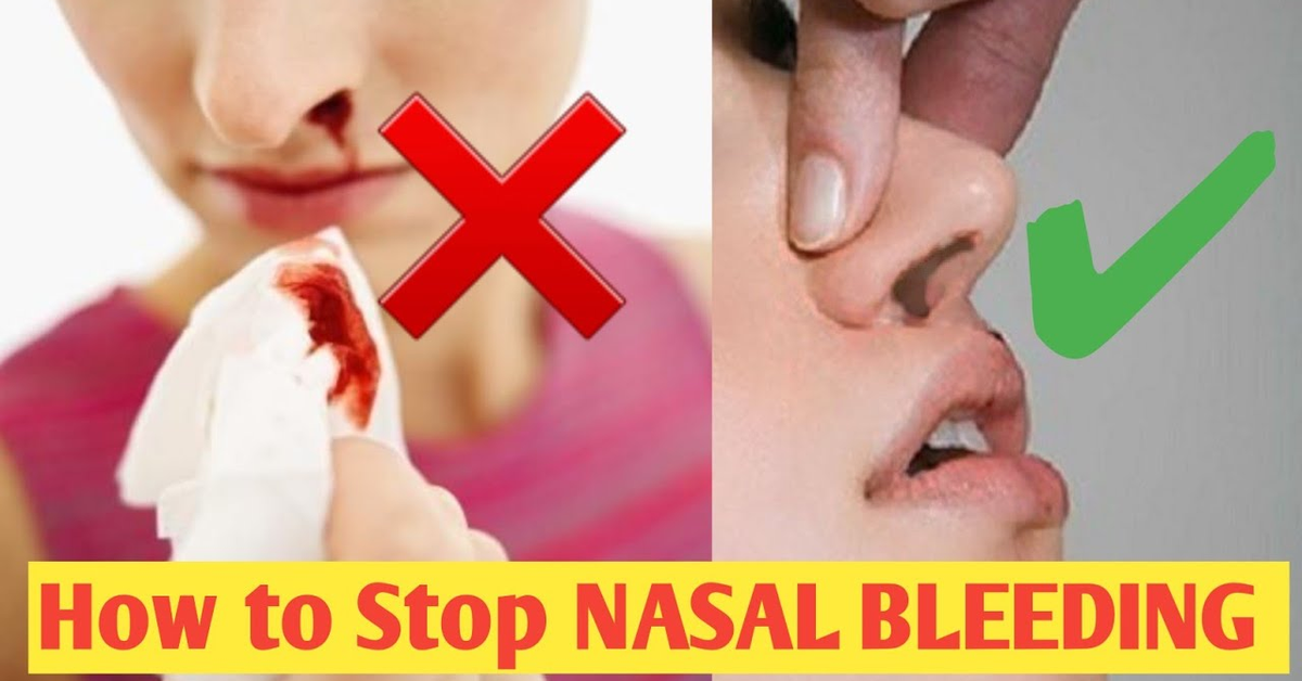 Stop a Nosebleed: Simple First Aid Guide | ምንሳር ደም ከመይ ጠጠው ነብሎ??