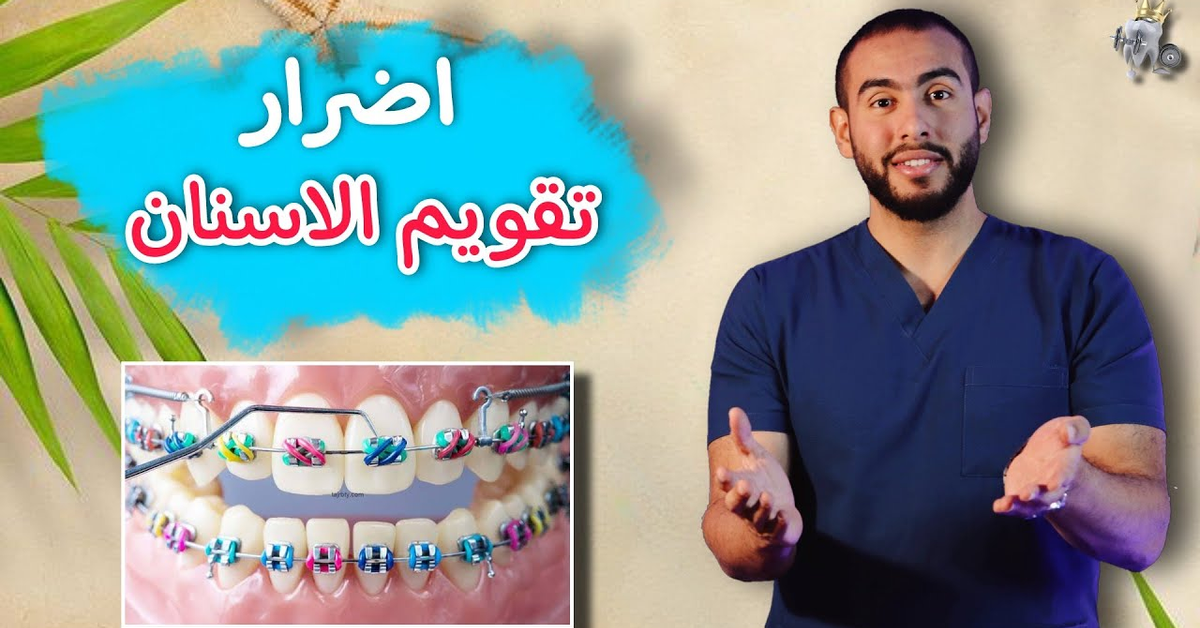 كوارث بيسببها تقويم الاسنان لو هتركب تقويم اسنان يبقى لازم تشوف اضراره بسرعه اضرار وفوائد التقويم