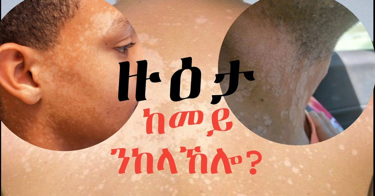Tinea Versicolor 101: Everything You Need to Know | ዙዕታ እንታይ እዩ?
