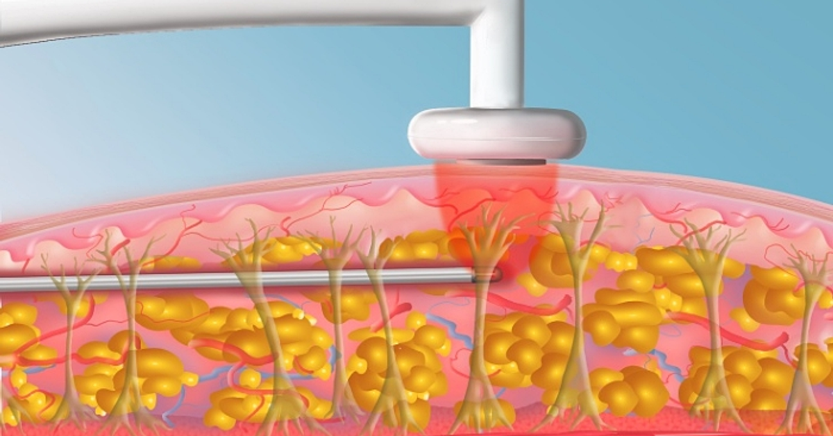 EmbraceRF鈦特離子夾是什麼？FaceTite/BodyTite超越電波的微創溶脂新選擇！